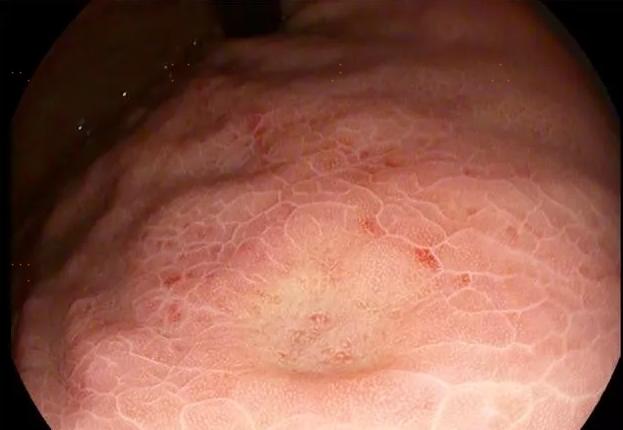 26岁女孩体检正常为什么还会癌变,39岁女性做了很多检查没发现原因