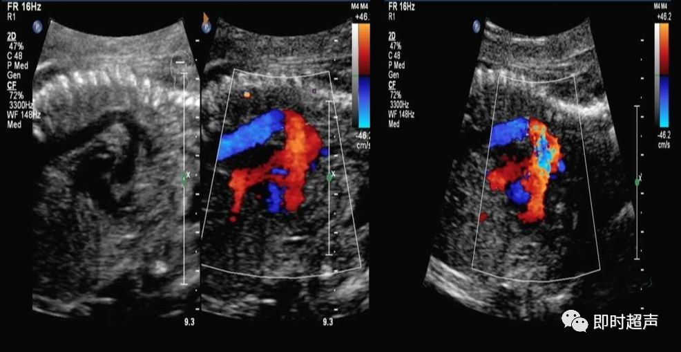 胎儿心脏三种血管关系模式图,25周的胎儿心脏弓切面多少正常