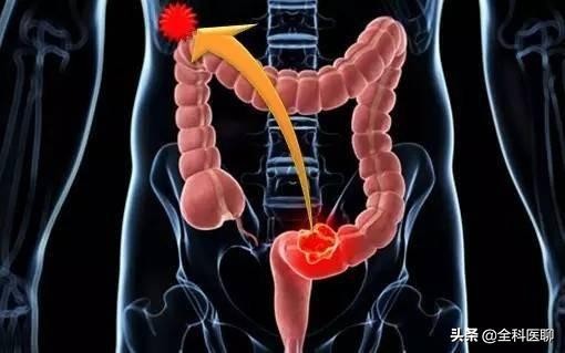 肠道造瘘能彻底治愈吗,肠道造瘘的利与弊