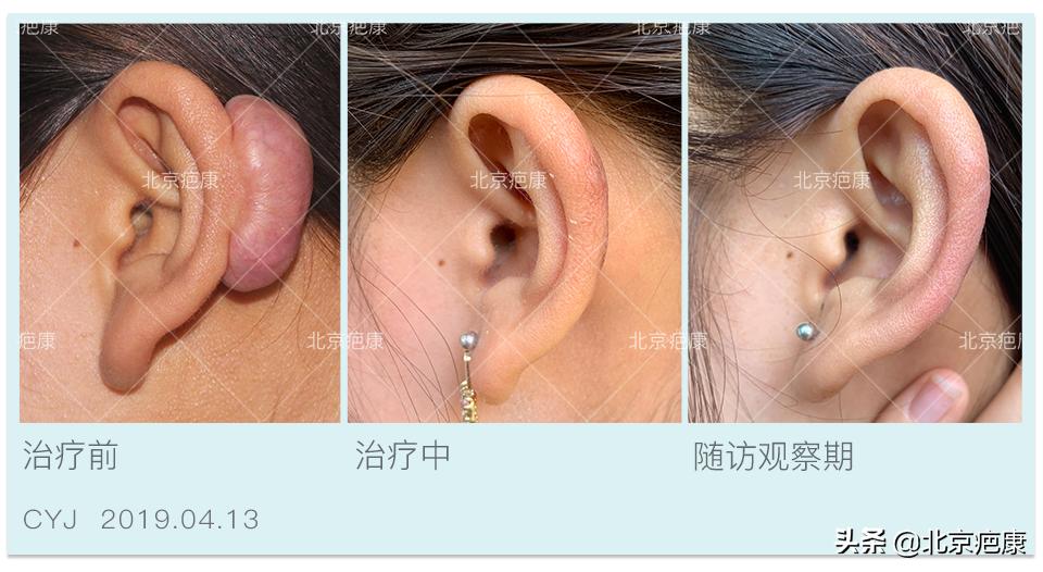 怎么判断瘢痕疙瘩是否复发,瘢痕疙瘩如何彻底治愈