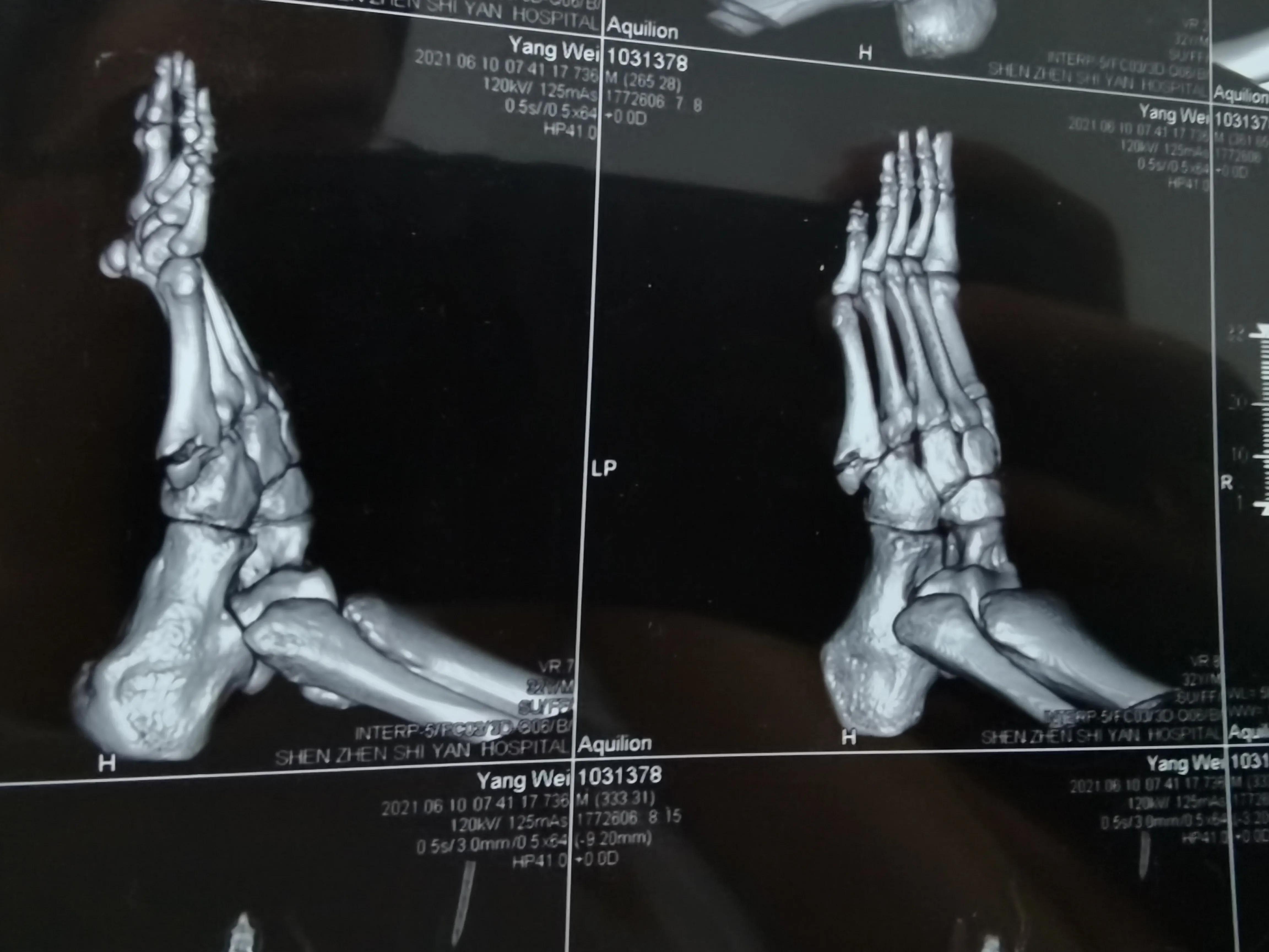 第五跖骨基底部骨折60天能走路吗,第五跖骨基底部骨折60天能脱拐吗