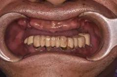 佛山种植牙齿全过程,南京牙齿种植案例分享