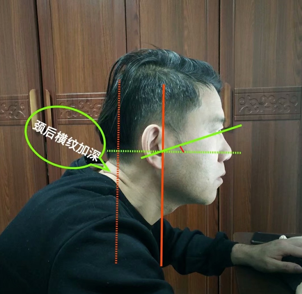 经常低头看手机的颈椎怎么矫正,抬头看手机对颈椎有好处吗