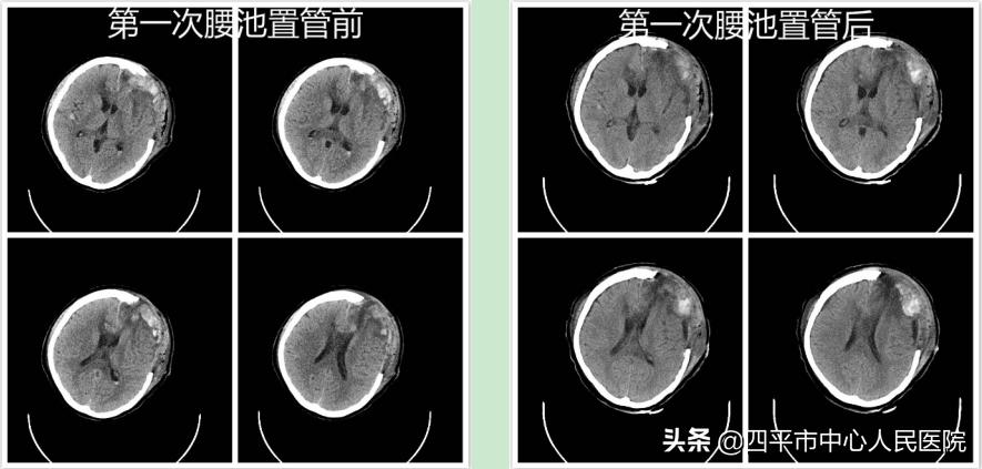 再创生命奇迹——神经外科成功救治白血病继发脑出血病危患者