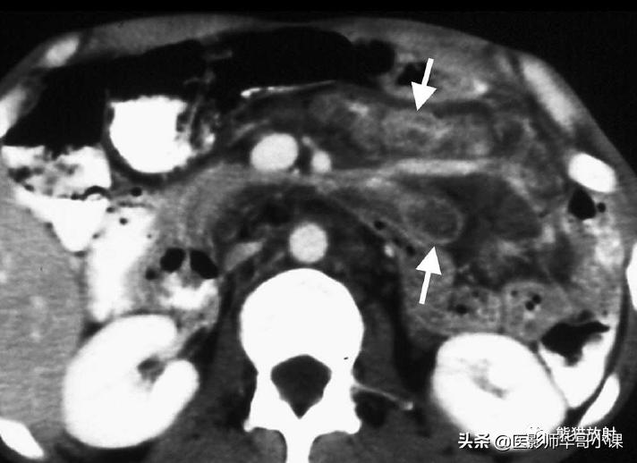 「精品课件」11种腹膜感染/炎症性病变的影像学表现