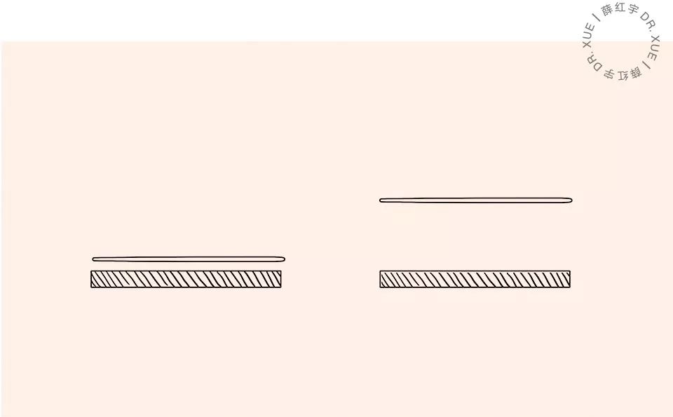 无痕双眼皮大概要多少钱,无痕双眼皮闭眼有痕