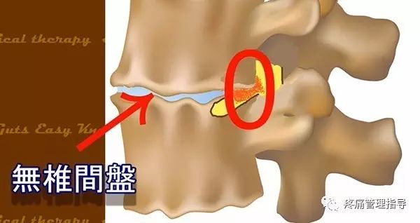 72岁老人腰疼还有骨刺该怎么治疗,老年人骨刺疼痛怎么治疗