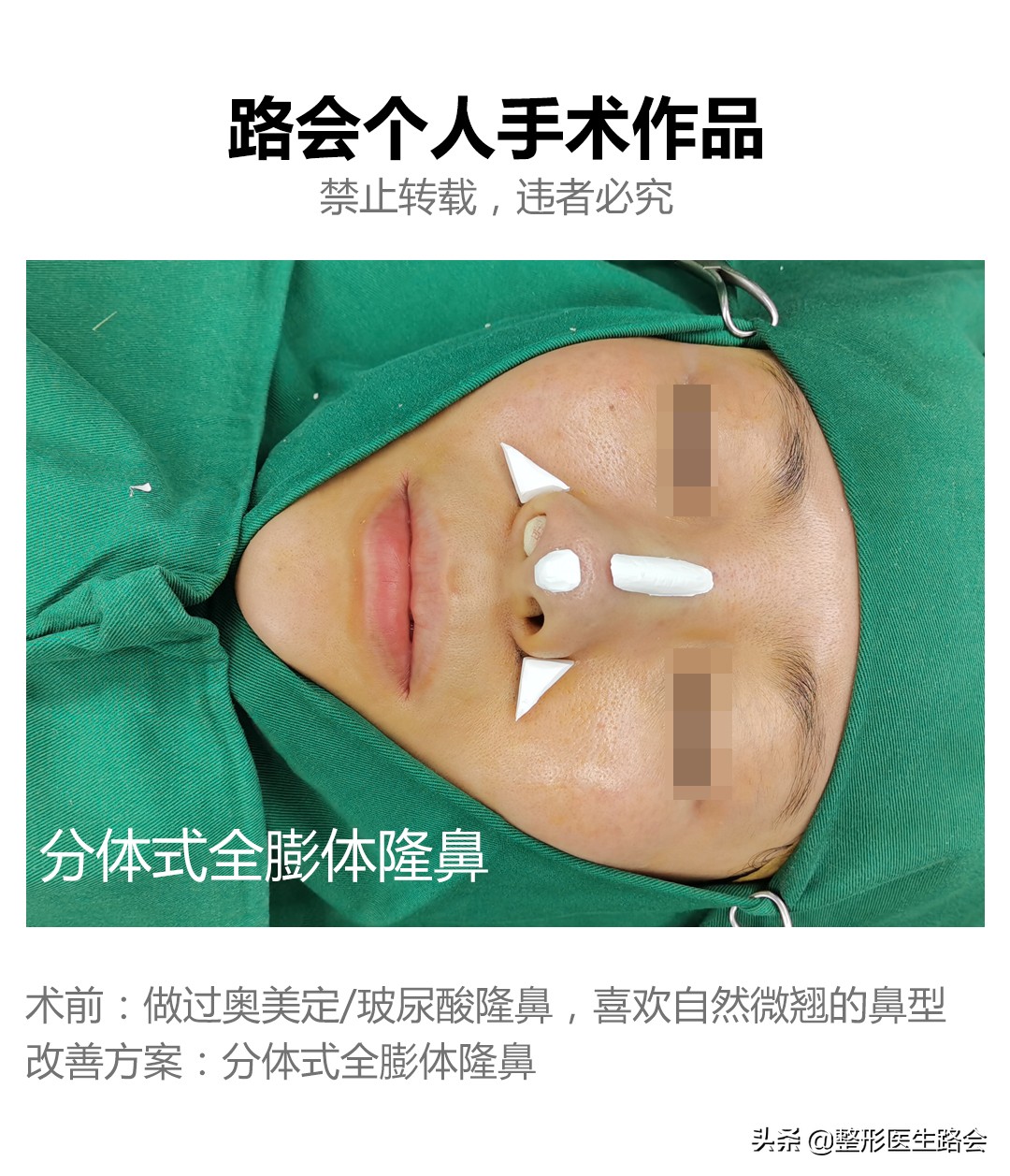 膨体隆鼻很假吗,膨体隆鼻假不假