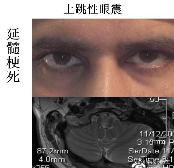 良性位置性眩晕鉴别,怎样判断眩晕是颈椎还是耳石症