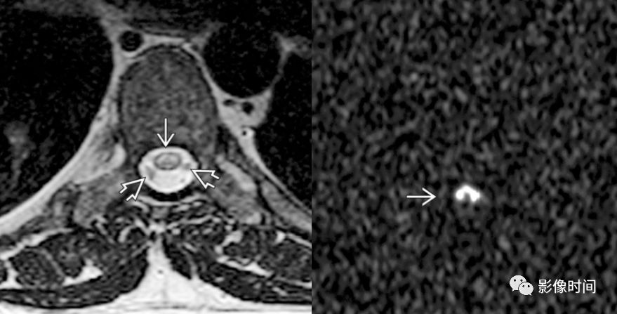 脊髓病变案例图文问诊,脊髓病变视频