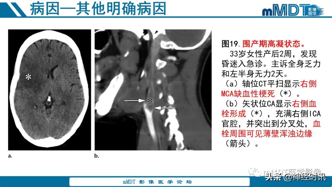 缺血性脑卒中护理课件,缺血性脑卒中讲课ppt