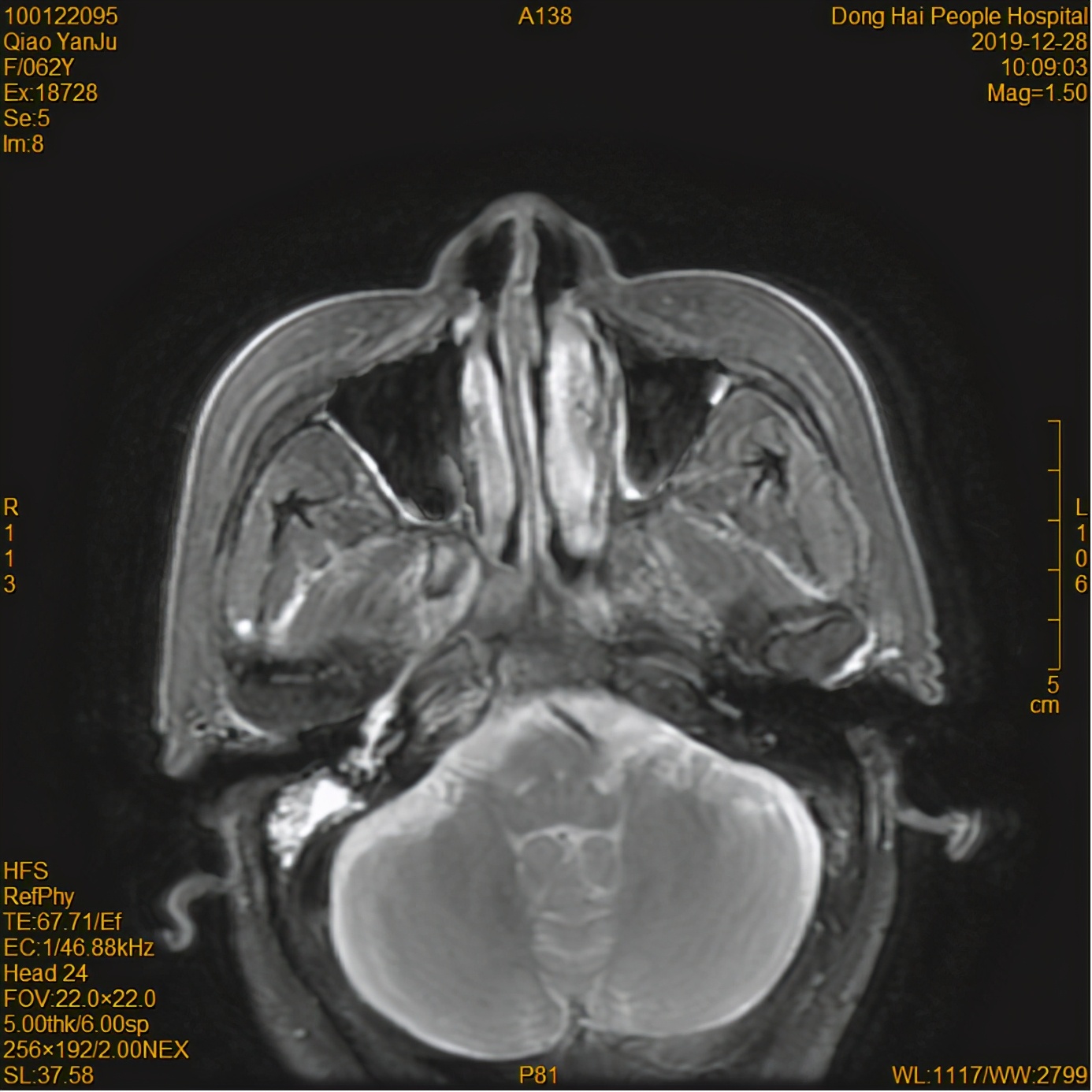 为什么鼻咽癌首选放疗,为什么鼻咽癌首选治疗方式是放疗