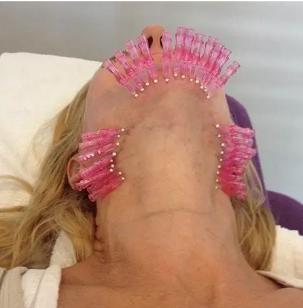 埋线面部提拉怎么样，做线雕能保持多久，不了解清楚还敢做？