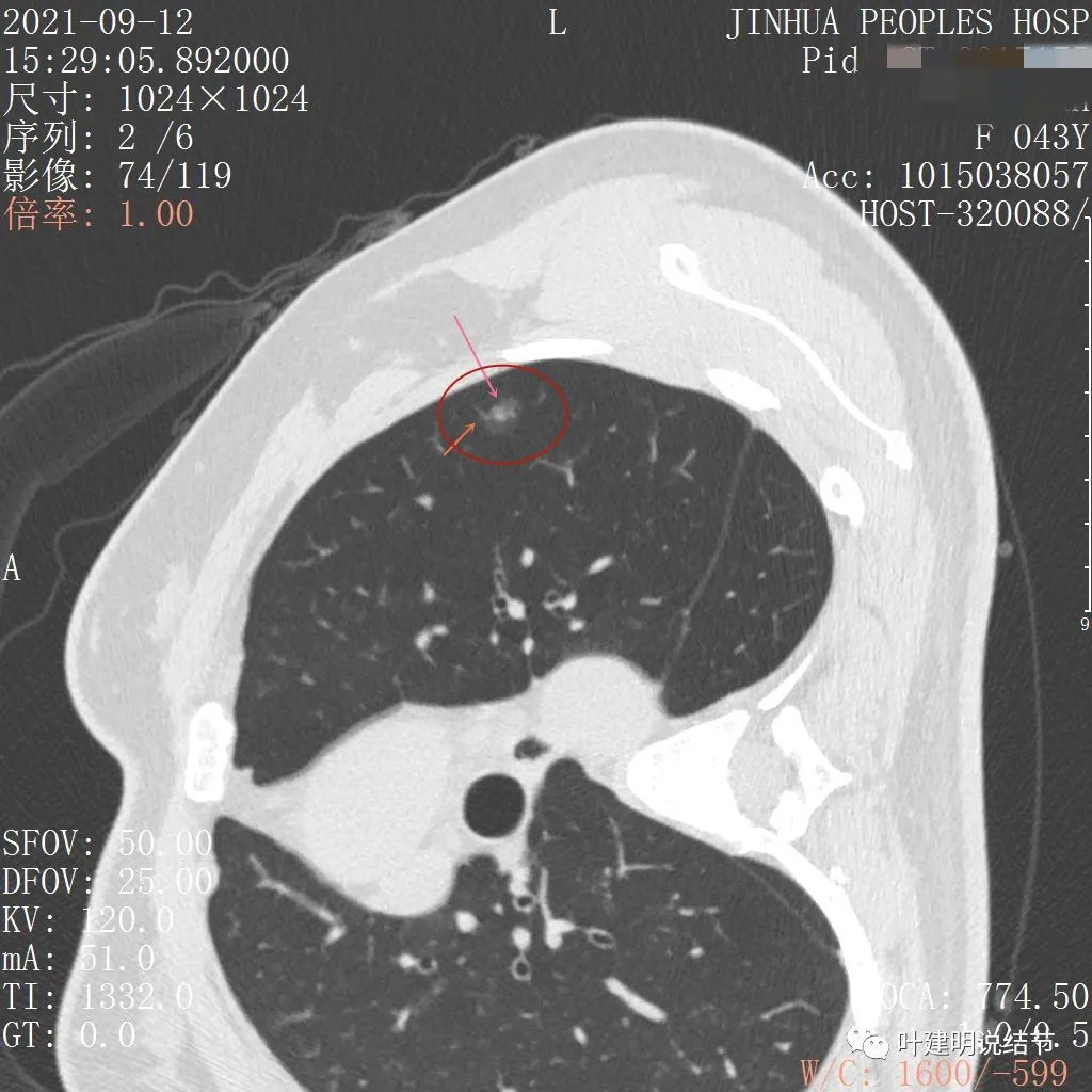 怎样从病理报告看是不是原位癌,原位腺癌切除子宫要开刀吗