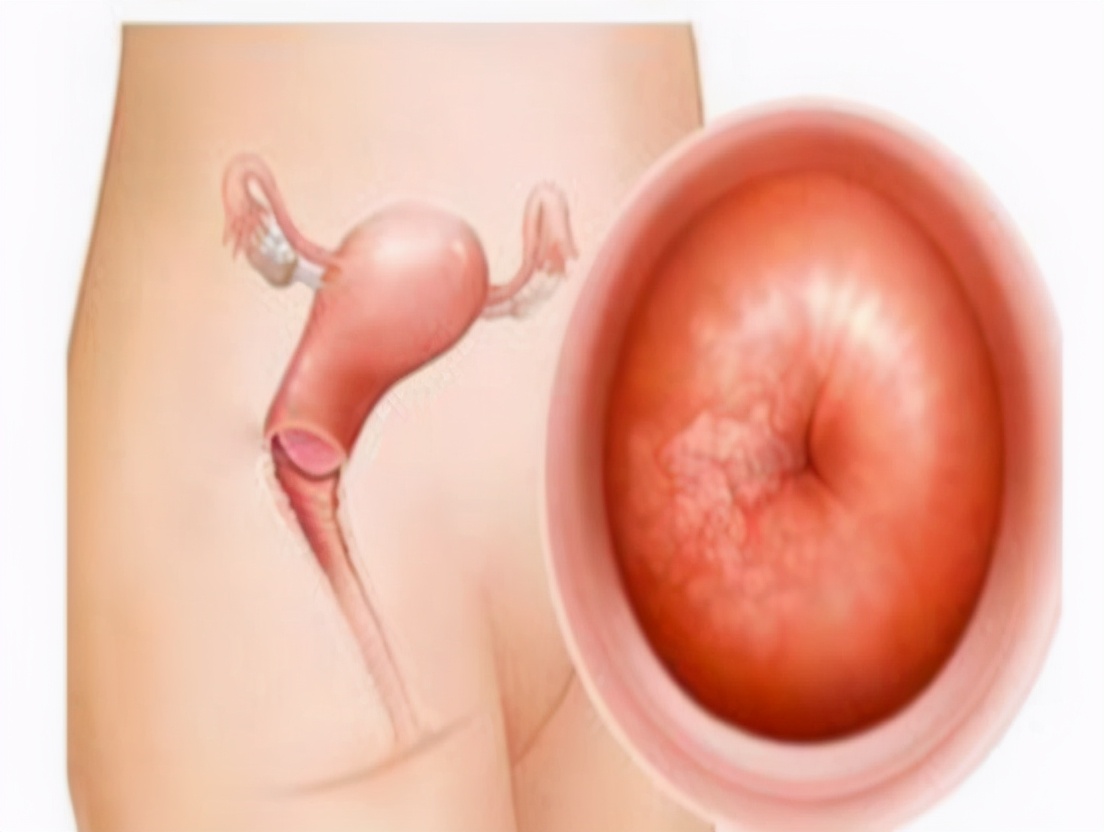 女性腿疼是宫颈癌的早期预兆吗,女性双腿疼痛查出宫颈癌