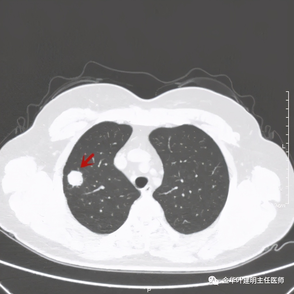 右上肺结节灶一般是什么癌,右上肺恶性肿瘤是肺癌吗