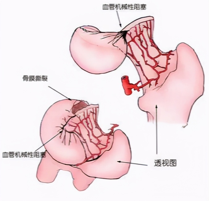 股骨头坏死能导致肌肉萎缩吗,股骨头坏死腿肌肉萎缩怎样锻炼