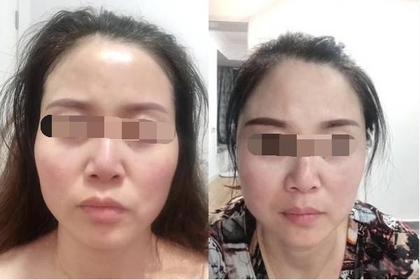 凹陷脸怎么整形,面部凹陷显老怎么整