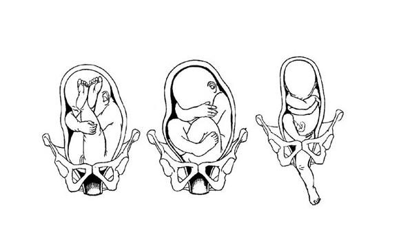 29周胎儿臀位该怎么办,胎儿臀位怎么纠正啊