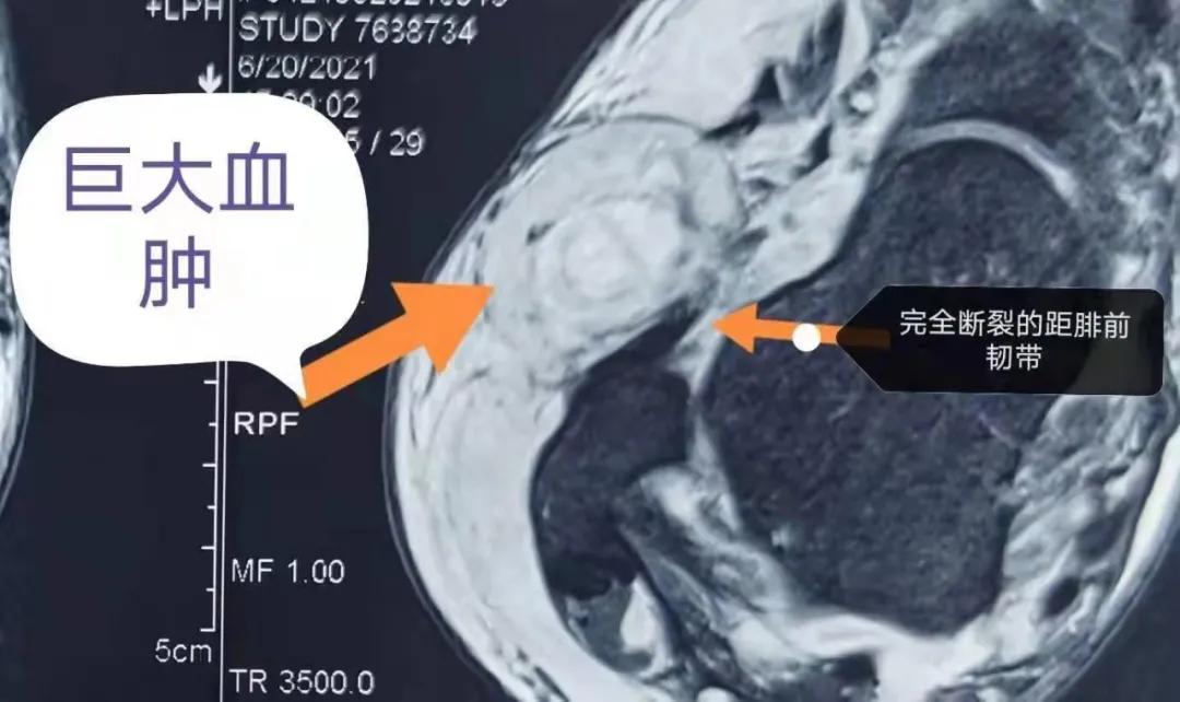 踝关节习惯性扭伤能治愈吗,踝关节扭伤是否伤到骨头