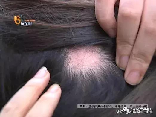 杭州漂亮女孩扎马尾头皮一下秃了四块！她怀疑那次在理发店……