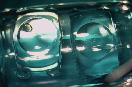 激光近视手术体验,半飞秒近视手术亲身经历