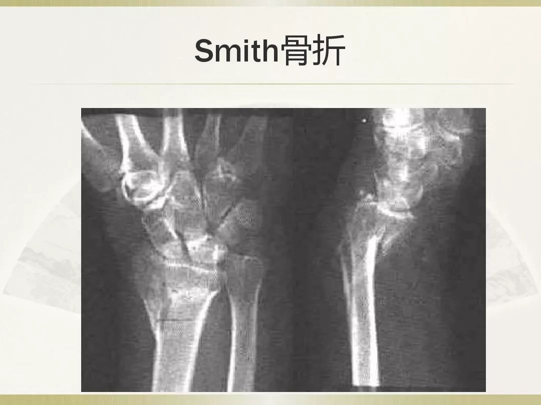 骨科x光片读片技巧,放射科骨科读片教程