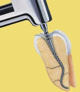 根管治疗没问题为什么牙还是难受,根管治疗为什么5年后根管会发炎