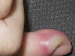 关节炎辟谣,膝关节滑膜炎辟谣