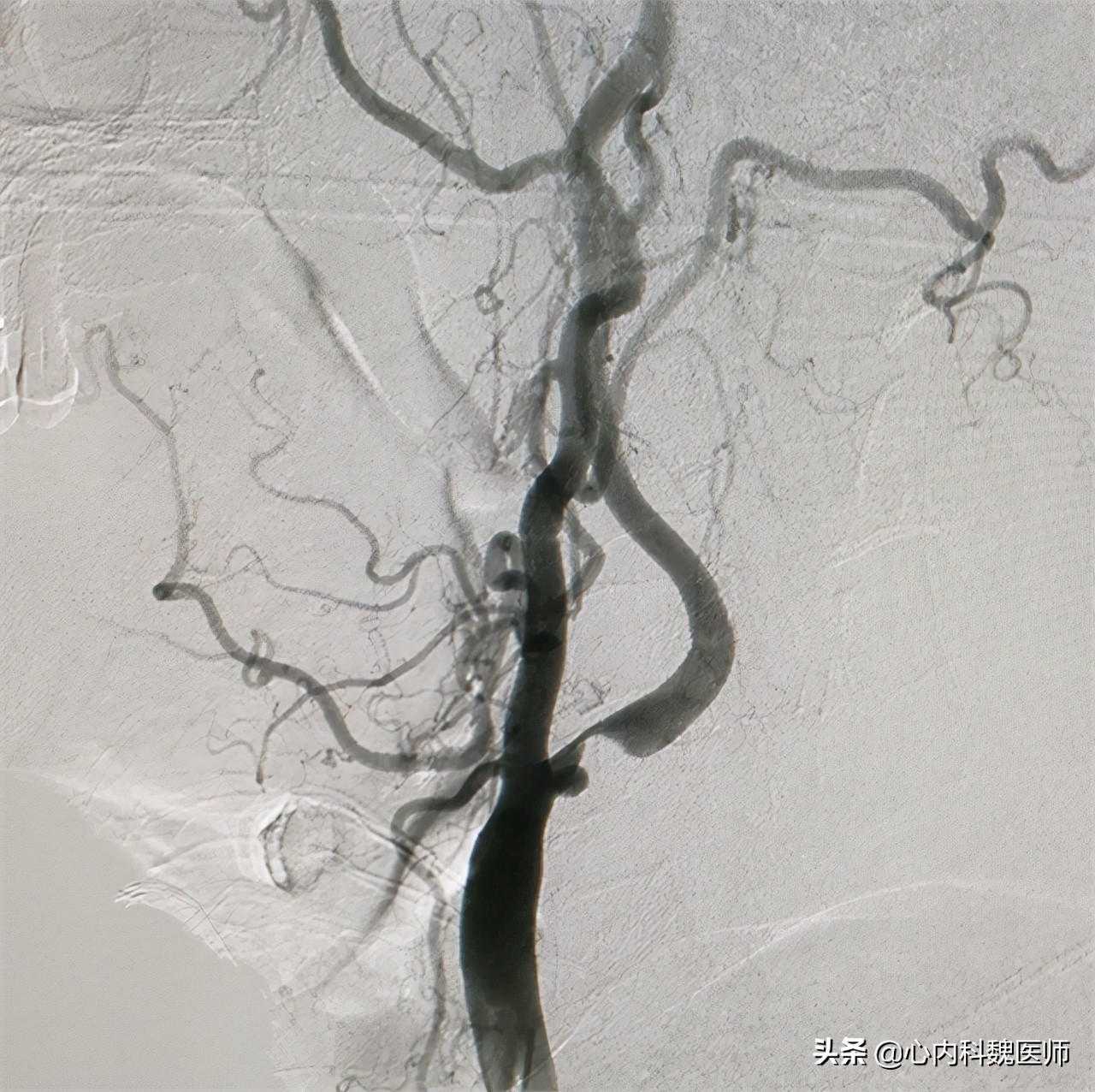 为何中国脑梗越来越多？医生：除了补充叶酸，做好这三点更重要