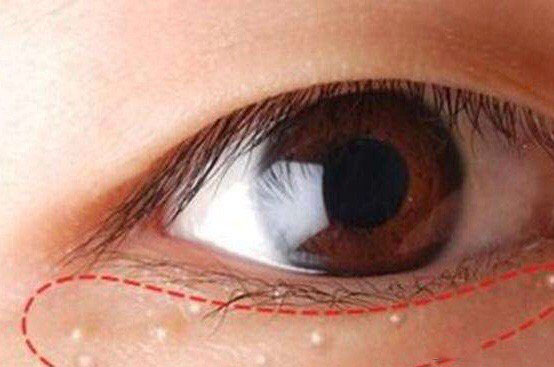 达人教你巧妙祛除眼部脂肪粒,眼部脂肪粒怎么去除小偏方图解