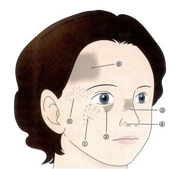 怎样辨别太田痣,婴儿太田痣扩散到几岁能稳定