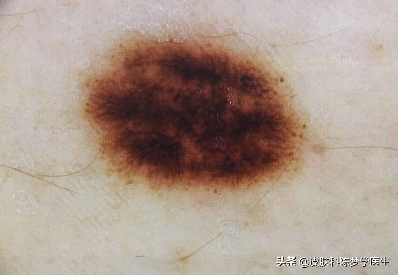 激光点痣后怎么判断有没有癌变,激光点痣会诱发痣癌变是真的吗