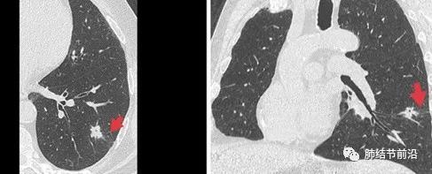 肺癌的肺泡间转移,STAS对肺结节临床处理的指导意义