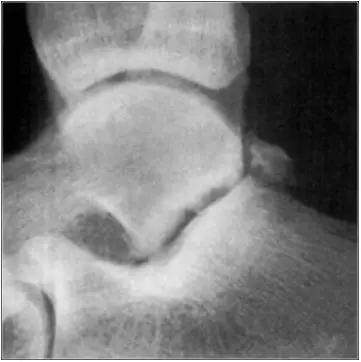 踝关节撞击症问诊,踝关节撞击综合征的x线表现