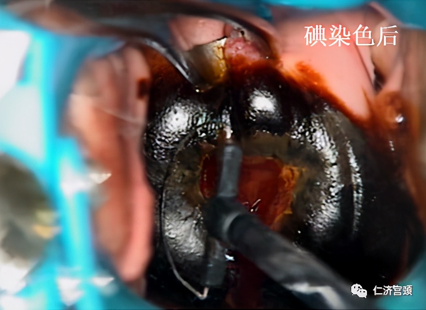 leep手术后遗症,锥切leep手术