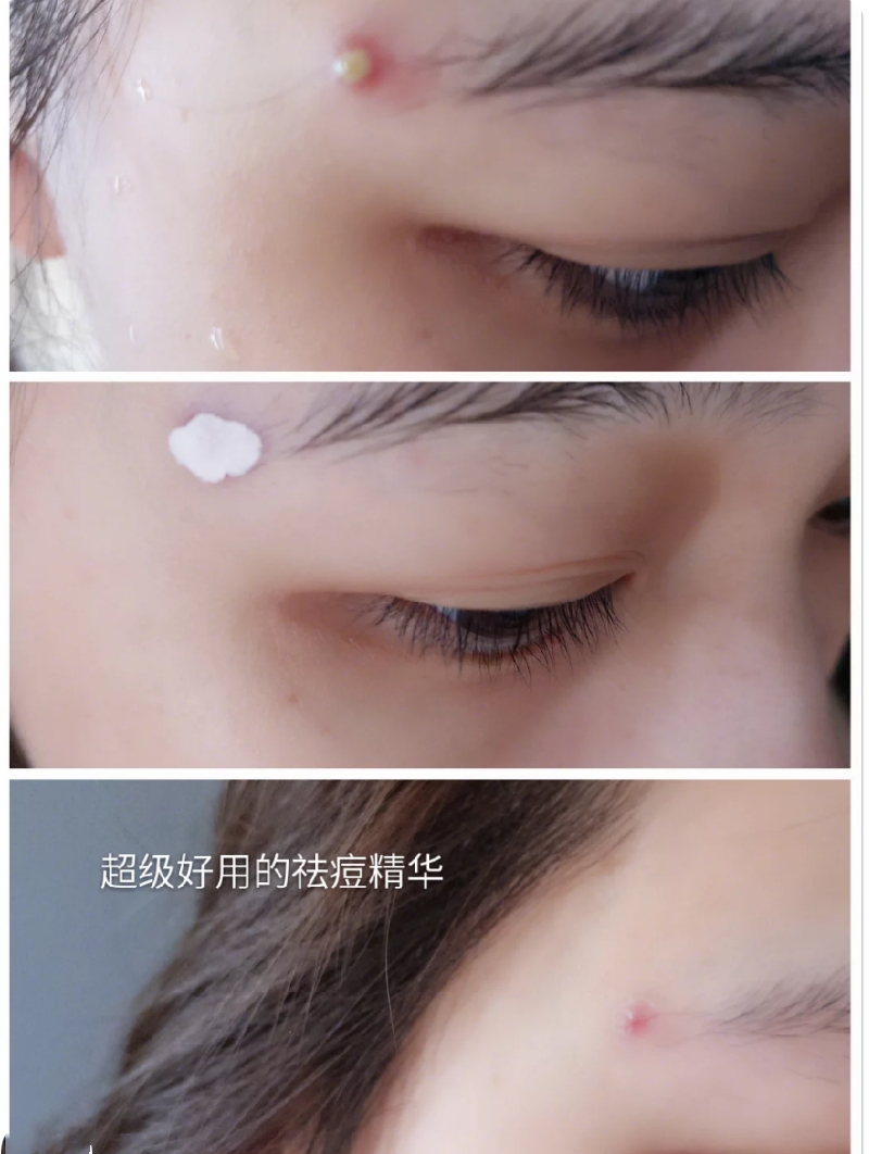平价祛痘精华液,祛痘祛痘印的精华液推荐