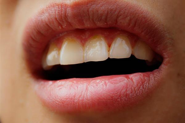 整牙堪比换头,整牙堪比整容真人案例