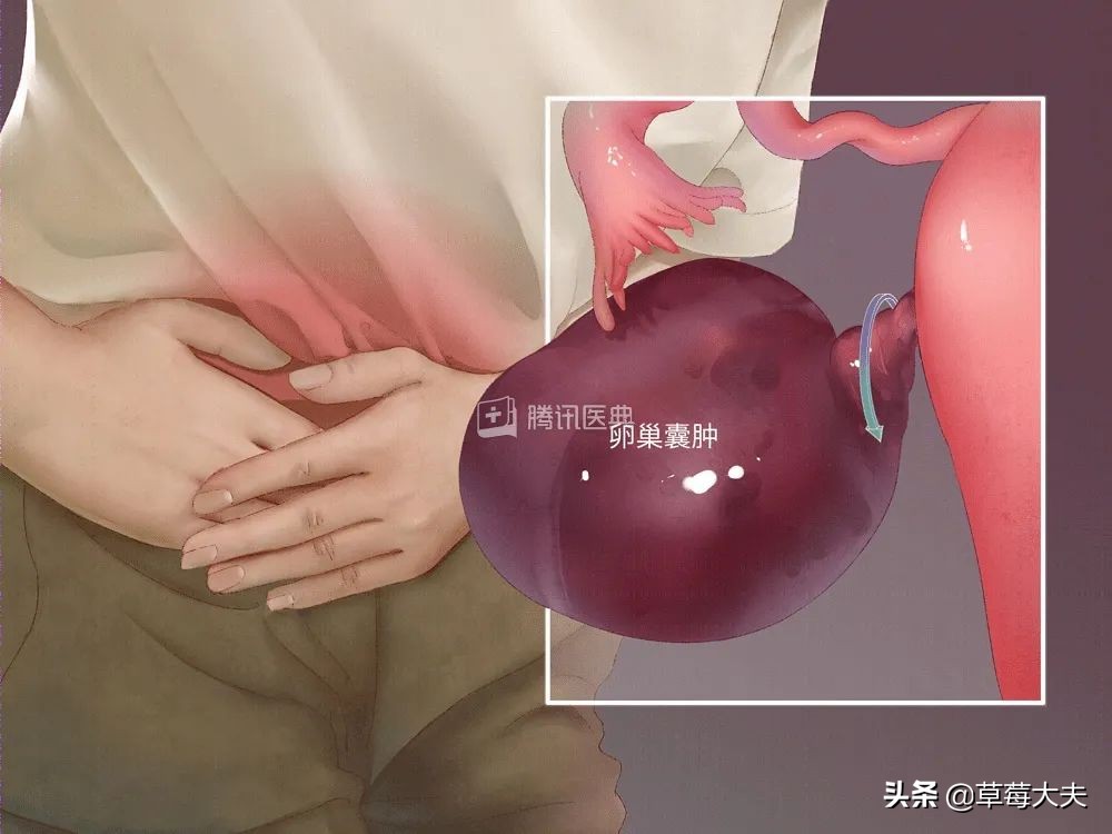 女娃腹痛,卵巢囊肿腹痛要做手术么