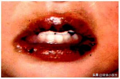 少儿川崎病,川崎病是什么样子的儿童