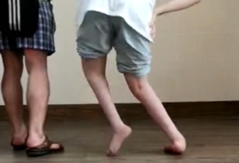 先天性马蹄足患者,先天性马蹄足后期会无法行走吗