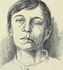 面瘫治疗在线咨询,发现有面瘫的前兆要去医院吗