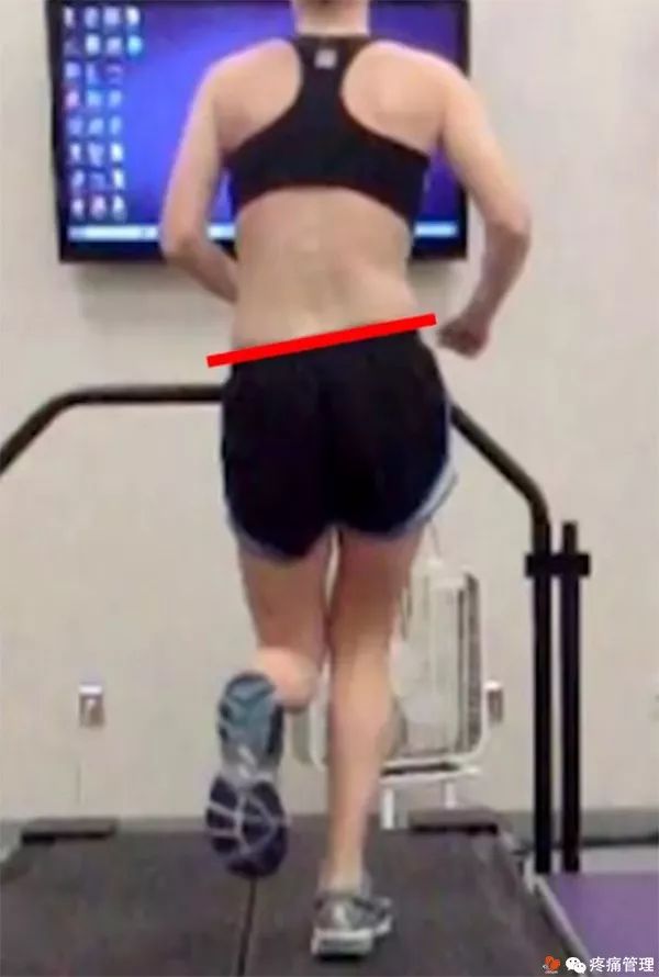 走路屁股扭来扭去是种病，还会导致腰痛、脚痛