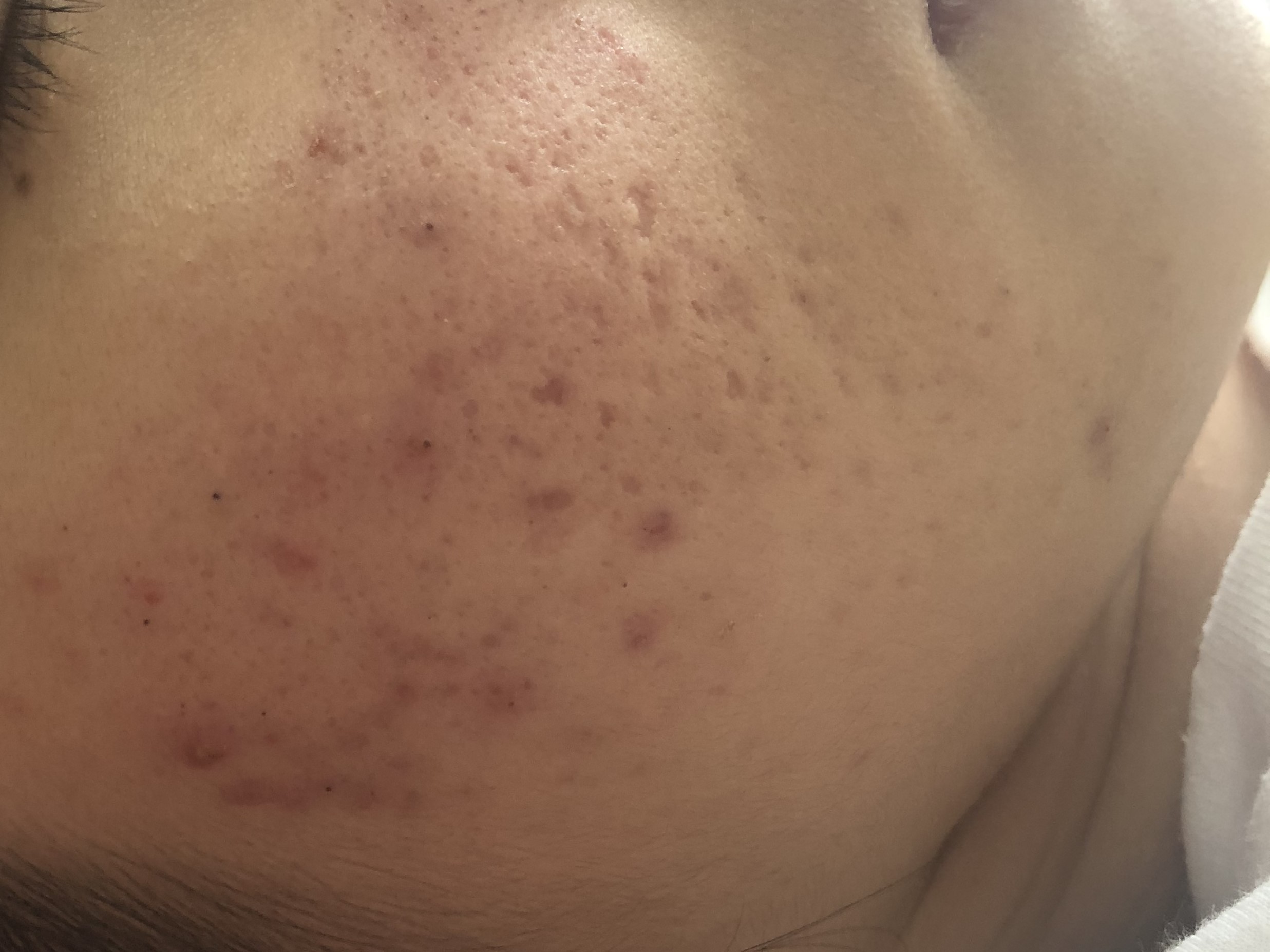 17岁女儿脸上长满痘痘，看了这篇文章才知道如何帮助她