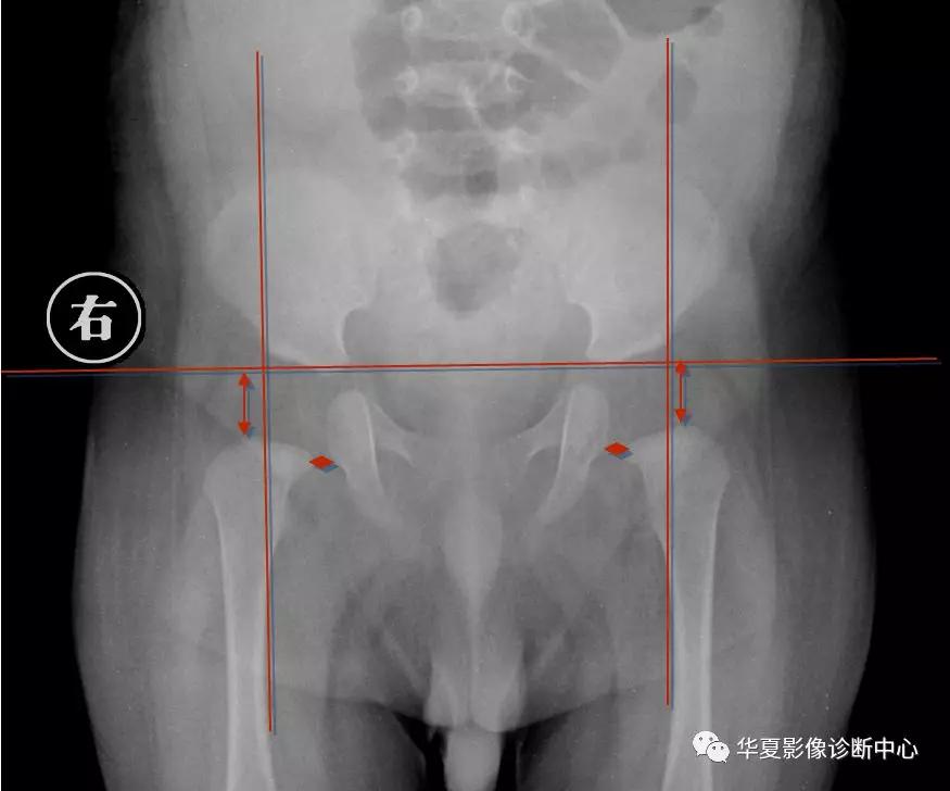 先天性髋关节脱位,先天性髋关节脱位属不属于残疾人