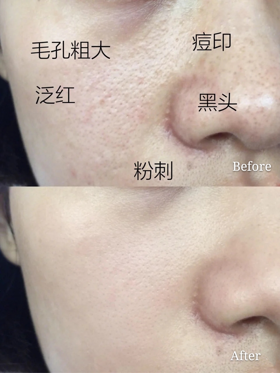 白天身上螨虫多是什么症状,身上螨虫多影响护肤吗