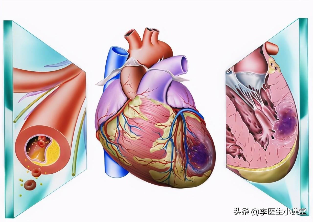 医生抢救心梗10秒自救方法,如果有突发性心梗该怎么急救