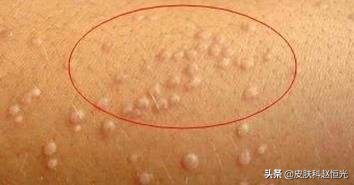 得了扁平疣要喝哪些中药调理,得了扁平疣口服什么药