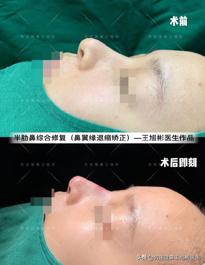 隆鼻的鼻翼怎么修复,隆鼻后多久可以做鼻翼缘矫正