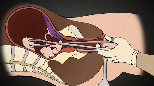 产科医生打胎女患者的结局,如何判断流产后胎儿是否彻底流产